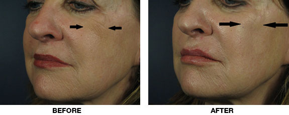 Before and After Image: Voluma XC - left-front-oblique