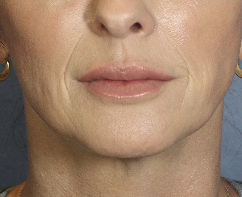 After Image: Vollure - front
